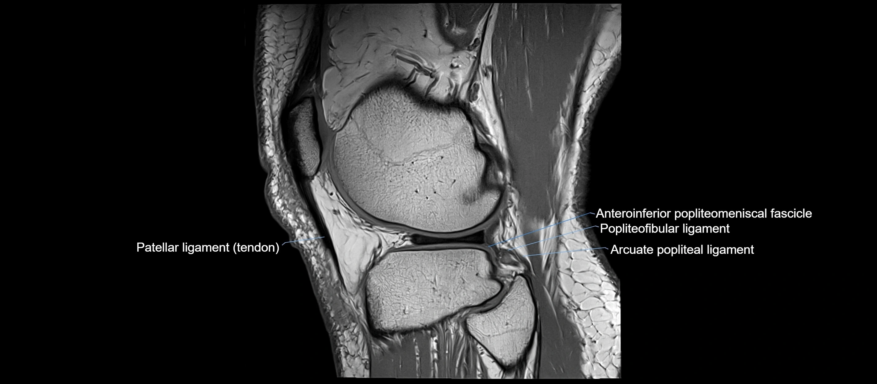 MRI sagittal  ligaments cross sectional anatomy 3T  radiology  image-img-00001-00038.webp
